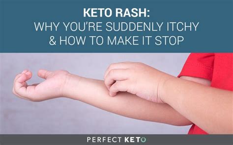 Keto Rash Why Youre Suddenly Itchy And How To Make It Go Away Keto