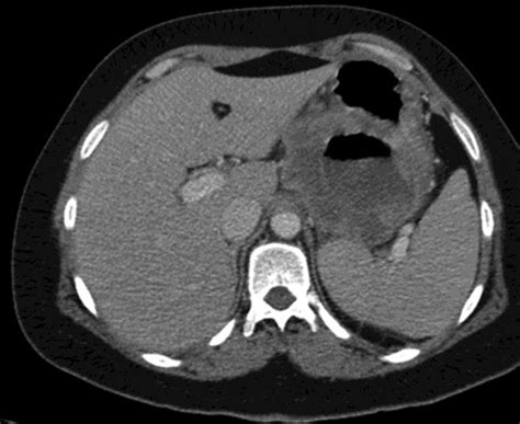 Abdominopelvic Ct Scan Showing A Hypodense Mass At The Lesser Curvature