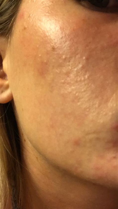 How To Get Rid Of These Bumps All Over Face General Acne Discussion Forum
