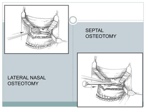 Maxillary Osteotomy Procedures Ppt