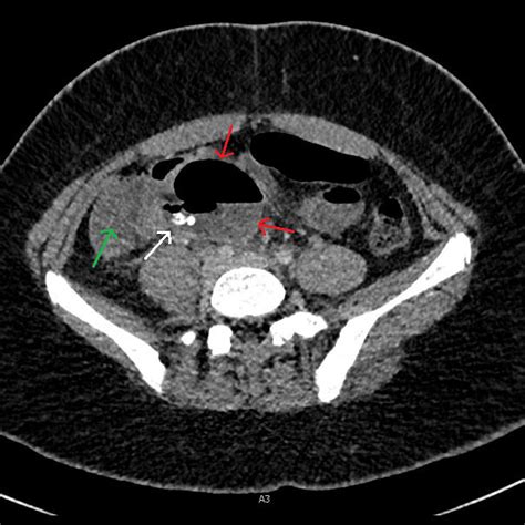 Preoperative Ct Axial Plane Demonstrating Appendix Rupture With A Gas