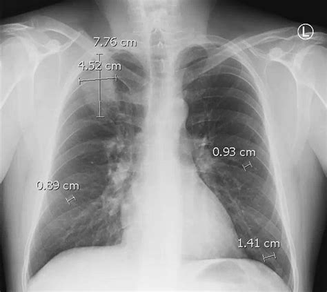 Chest X Ray Showing A Lobulated Mass At The Right Lung Apex Measuring