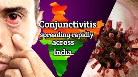 Why Conjunctivitis Is Spreading Rapidly Across India What Is Eyeflu