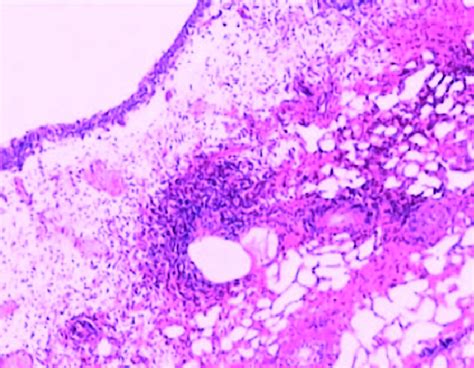 Eosinophilic Cystitis Was Confirmed Histologically 20Â Hematoxylin