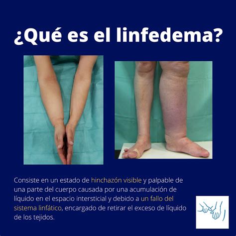 Enfoques Modernos Para El Linfedema Por Dianne Maxwel