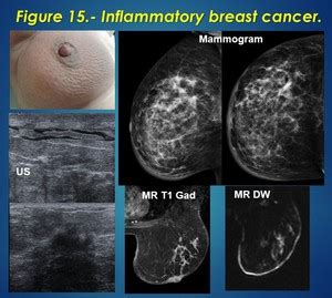 Cancer Detail Care Inflammatory Breast Cancer
