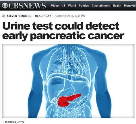 News In Proteomics Research Potential Urine Test For Pancreatic Cancer