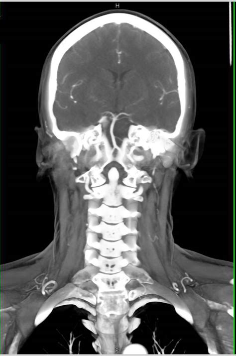 Normal Neck Ct Scan