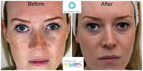 Perfect Derma Peel To Treat Sun Damaged Skin