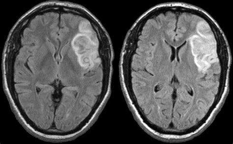 What happens if stroke is damaged more superficial area of the cortex? Study Medical Photos: A 63 Year Old Man Presents With ...