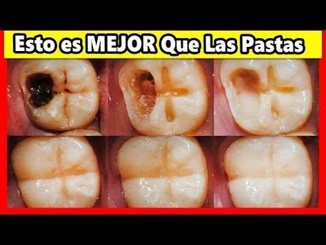 Ning N Dentista Quiere Que Sepas De Este Remedio Porque Te Quita Las