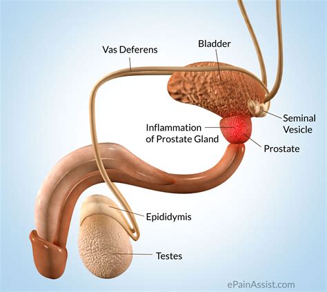 Prostate Pain Classification Types Etiology Risk Factors Signs Symptoms Treatment