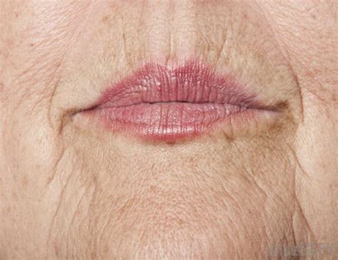 Causes Of Wrinkled Lips And Fast Removal Methods Skincarederm