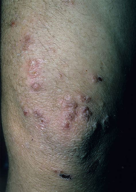 Dermatitis Herpetiformis Pictures Pictures Photos