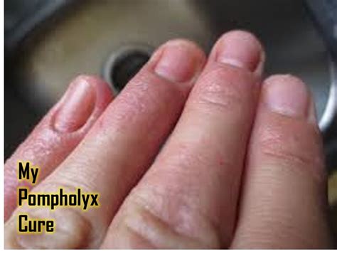 Pompholyx Pictures Symptoms Treatment Diagnosis Causes Cure Images