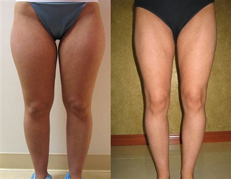 Stubborn saddlebags and fat that causes the inner thighs to rub against each other are. Inner Thigh Liposuction for Fat Thighs - Liposuction ...
