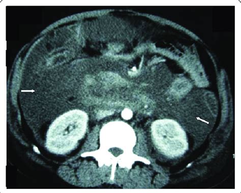 Contrast Enhanced Computed Tomography Of Pancreas When The Patient Was