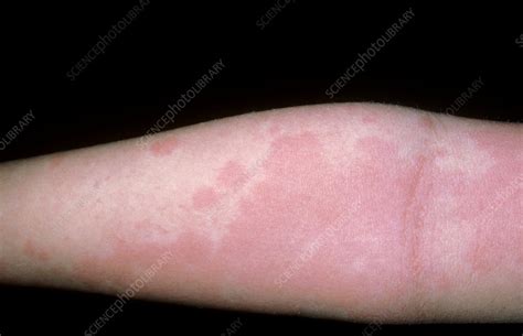 Urticaria Rash On Arm Stock Image M2800062 Science Photo Library