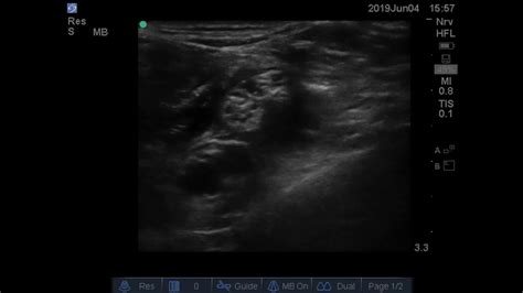 Ultrasound Guided Supine Popliteal Sciatic Nerve Block Youtube