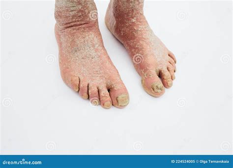 The Doctor Diagnoses The Injured Foot Dry Skin Psoriasis Of The Feet