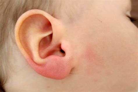 Die behandlung der geschwollenen lymphknoten hinter dem ohr sollte auf die beschwerden und die sowie symptome ansprechen, die den zustand begleiten. Zeckenbiss beim Baby: Rotes, geschwollenes Ohrläppchen ...