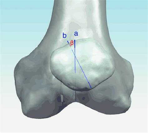 3 D Reconstruction Image Depicting The Angle Between The Patellar Ridge