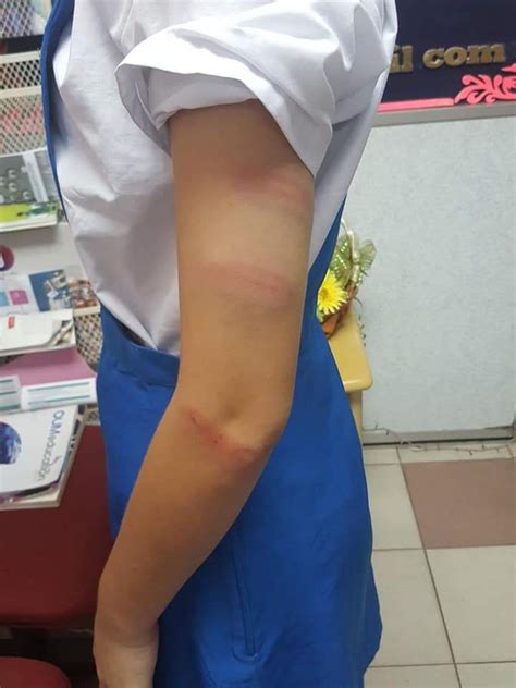 Schoolgirl Left With Bruises After Being Caned By Teacher