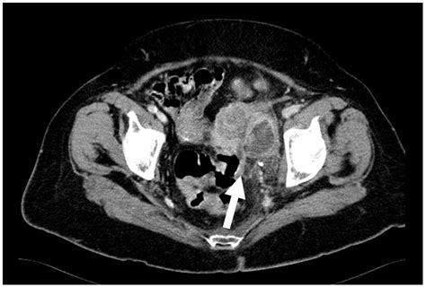 Ct Scan With Contrast Bowels Uterus Side View Fasrprinting