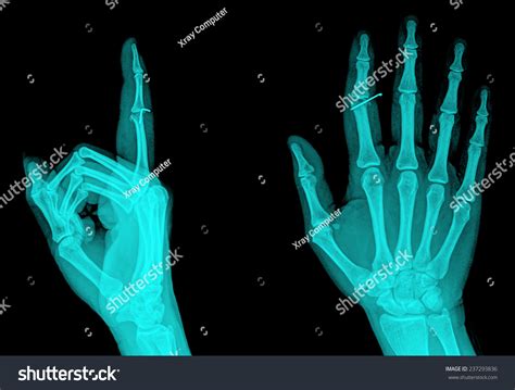 Xray Hand Showing Middle Finger Sign Stock Photo Shutterstock