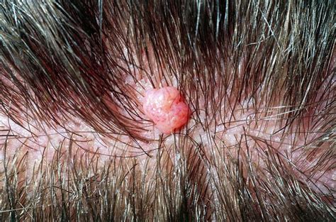 Close Up Of A Benign Mole On Scalp Of Young Man Photograph By Dr P