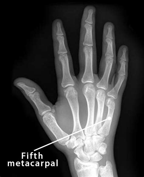 Fifth Metacarpal Definition Location Anatomy Diagram