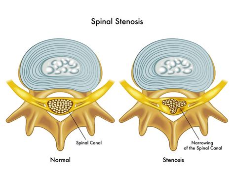 ﻿spinal Stenosis Surgery Know The Facts Texas Health Spine