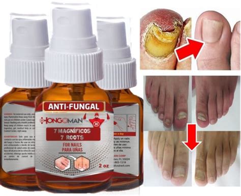 Anti Fungal Treatment Extra Strength Toenail Fungus Fungi Sp Nail