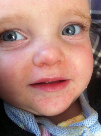 Caused by contact allergy or food/medication allergy. Is this a food allergy or drool rash? - BabyCenter