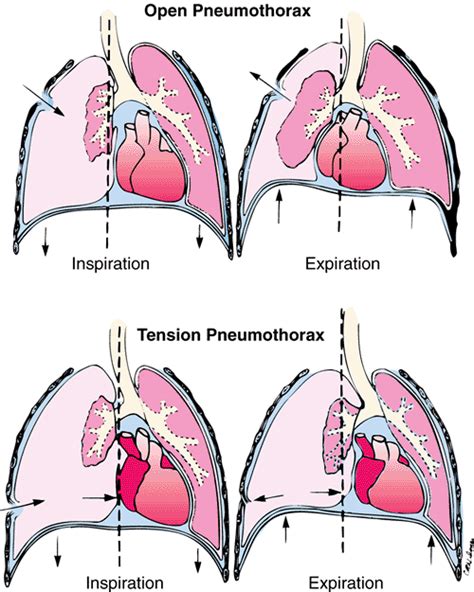 Diagram Of Open Pneumothorax And Tension Pneumothorax Nursing Stuff