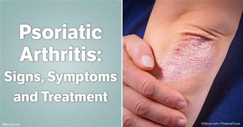 Psoriatic Arthritis The Agonizing Duo Of Skin And Joint Pain