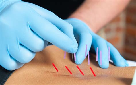 ims dry needling penticton physiotherapy