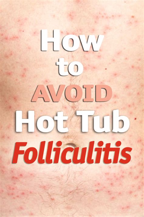Hot Tub Infection Folliculitis Acsbr Nccsea