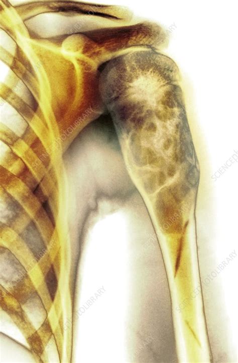 Benign Bone Cyst X Ray Stock Image C0207180 Science Photo Library