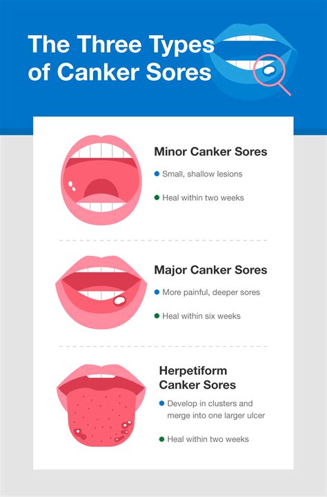 What To Know About Canker Sores The Bumps That Form On Your Mouth Or