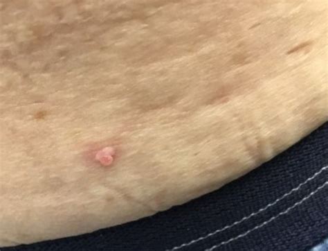 Derm Dx Flesh Colored Polypoid Lesion On The Abdomen Clinical Advisor