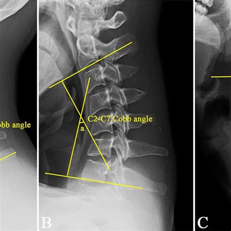 Measurement Of Cervical Sagittal Vertical Axis Sva C2c7 Cobb Angle