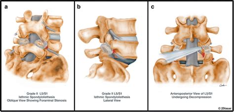 Decompression And Spinal Fusion In Low Grade Spondylolisthesis