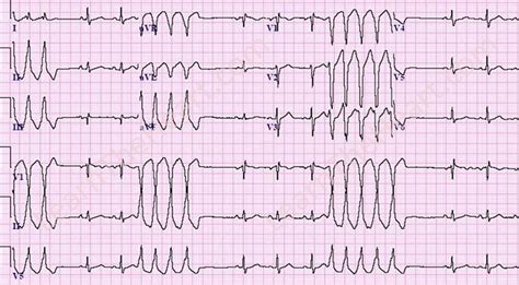 Non Sustained Ventricular Tachycardia Ecg Example Learntheheart Com