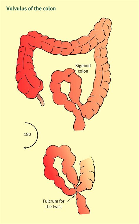 References In Sigmoid Volvulus Acquired Megacolon And Pseudo