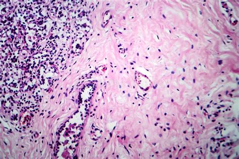 Breast Fibroadenosis Light Micrograph Stock Image Image Of Disease