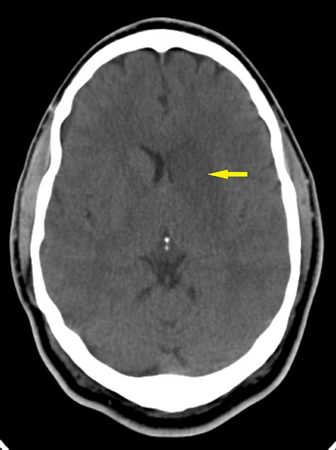 Cureus Pseudobulbar Affect Presenting As Aggressive Behavior