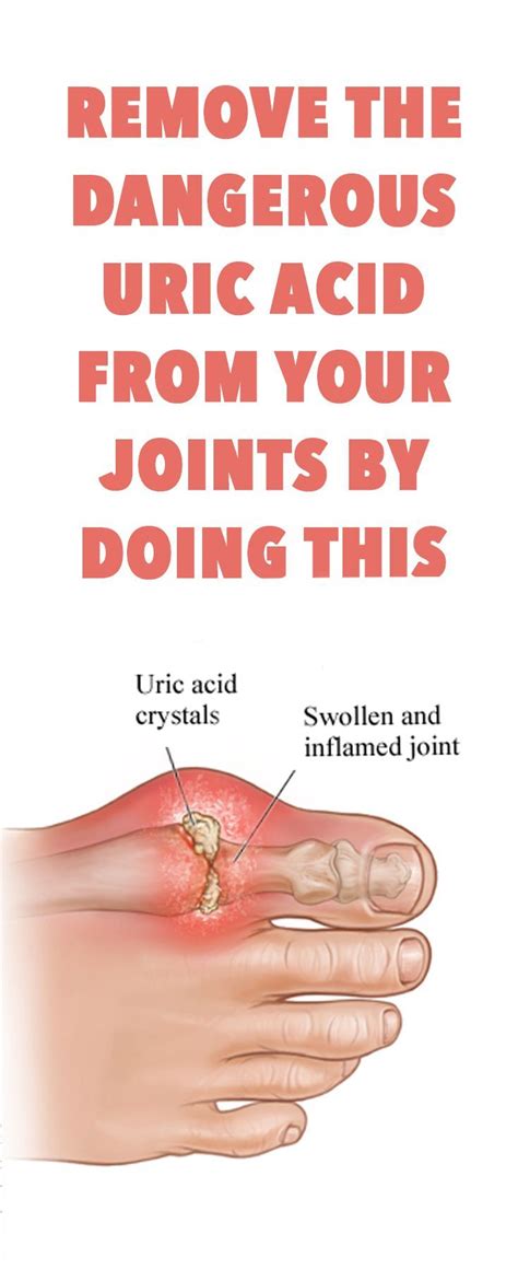 Eliminate Uric Acid Crystals In Joints Using These 8 Natural Remedies