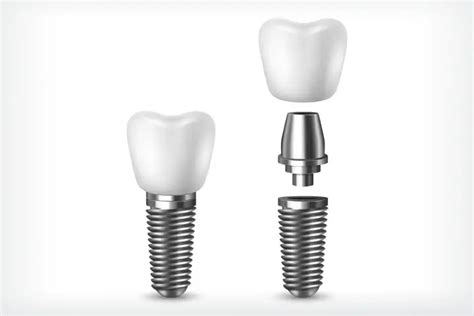 Implante Dentário Clínica Especialista Implantodontia e Prótese Dentária