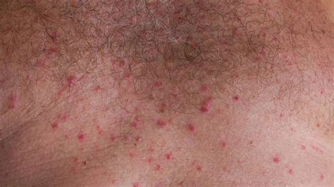 Rash In Groin Area Female Rashes In The Elderly Identification And